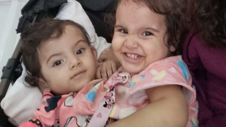 Qual a causa da morte da gêmea que não resistiu à cirurgia de separação que levou 19h?