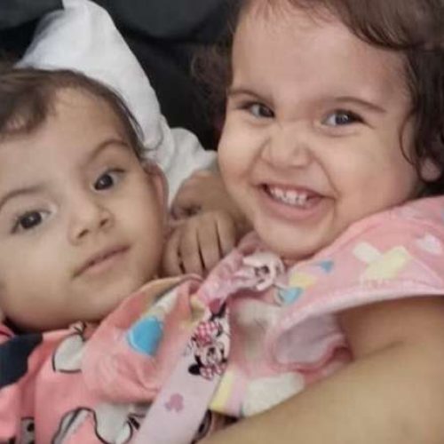Qual a causa da morte da gêmea que não resistiu à cirurgia de separação que levou 19h?
