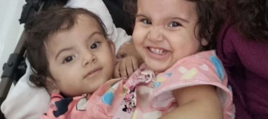 Qual a causa da morte da gêmea que não resistiu à cirurgia de separação que levou 19h?